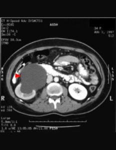 obstruction urinary tract pelvic dilated pelvis